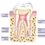 SafeEndo BioStructure MTA Root Repair Material