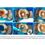 SafeEndo BioStructure MTA Root Repair Material