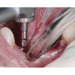 Woodpecker Implant Motor Irrigation Tubing for oral surgery