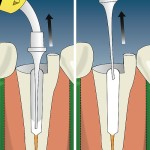 SafeEndo CalciCure